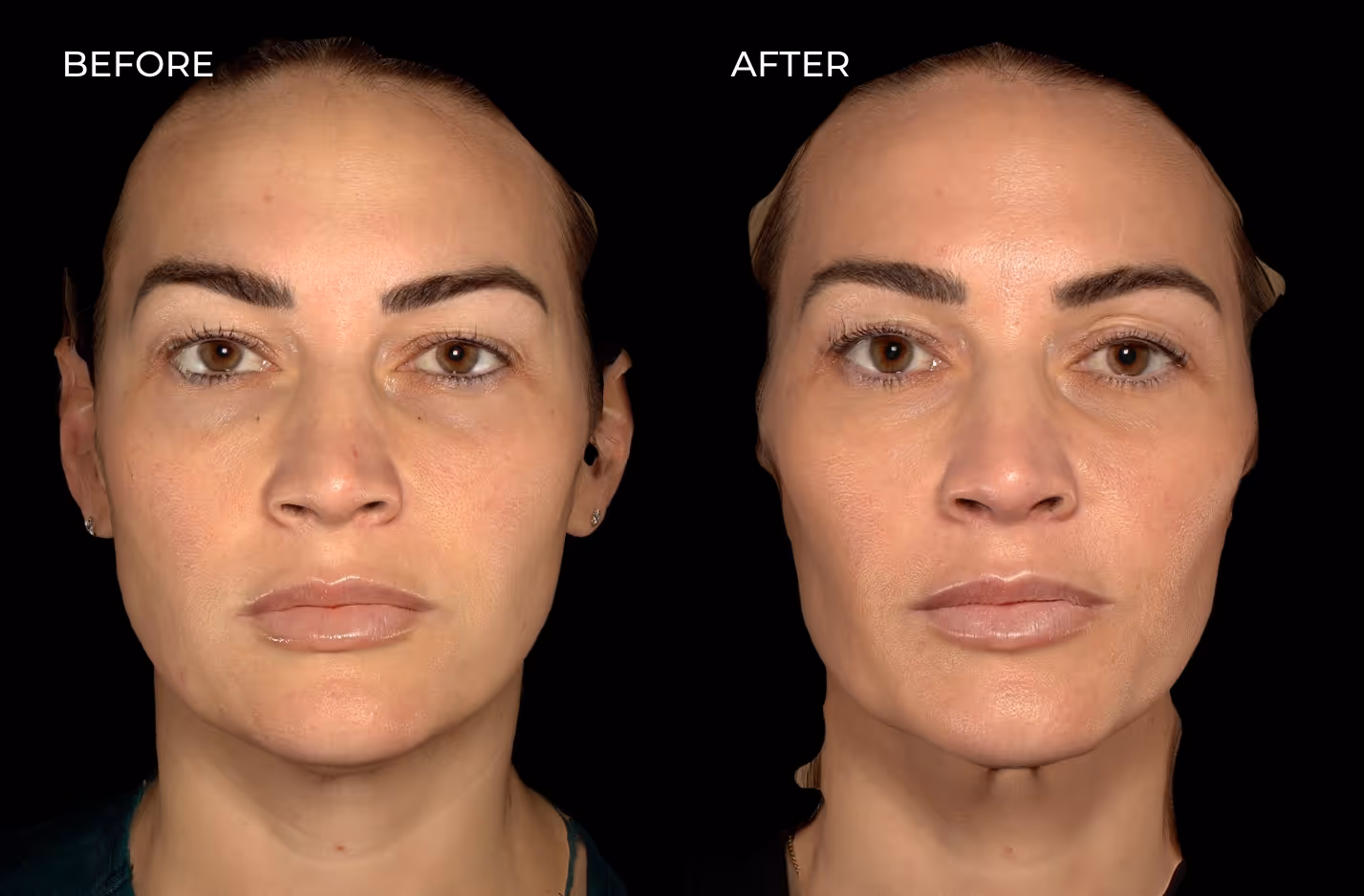Female patient before and after botox and fillers in San Diego