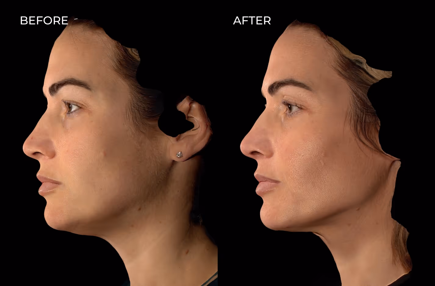 Female patient before and after botox and fillers in San Diego