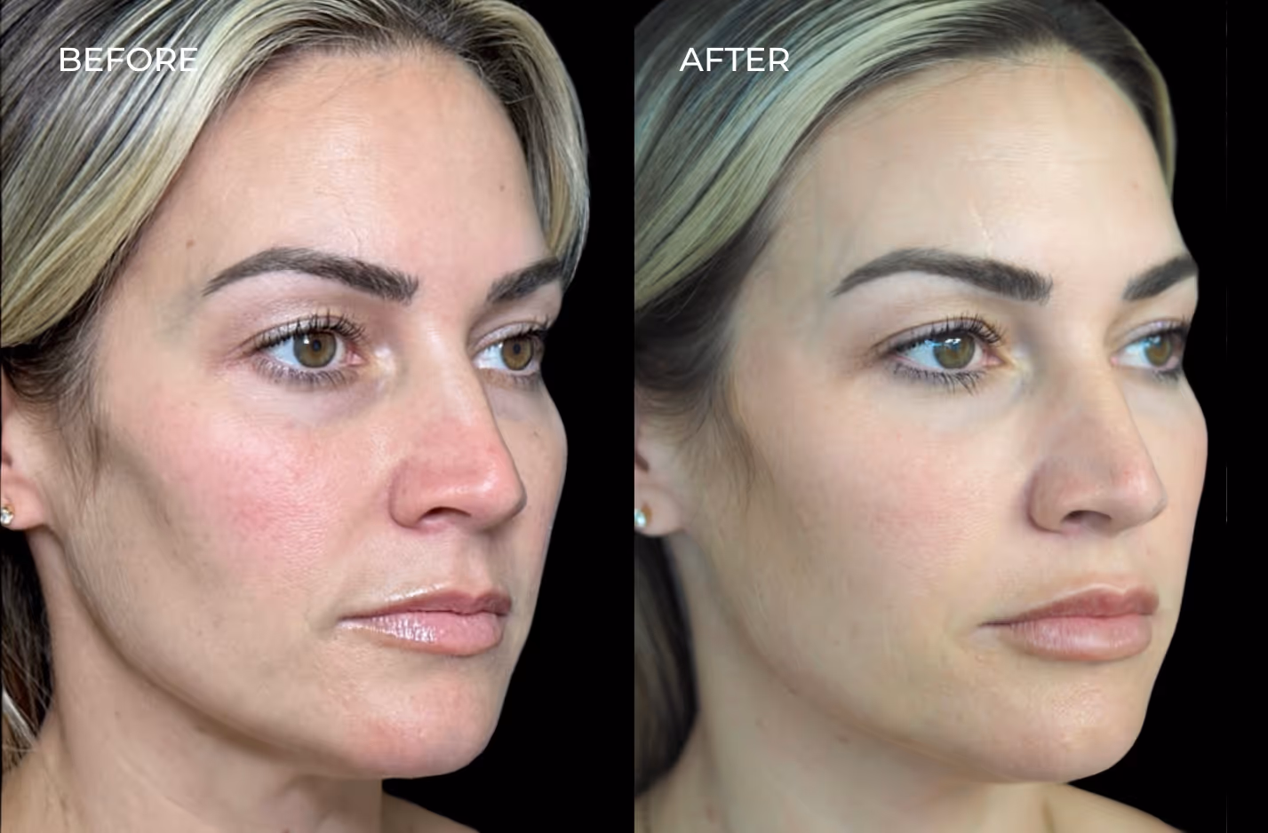 Frontal view of female patient before and after Sculptra and other injectables in San Diego