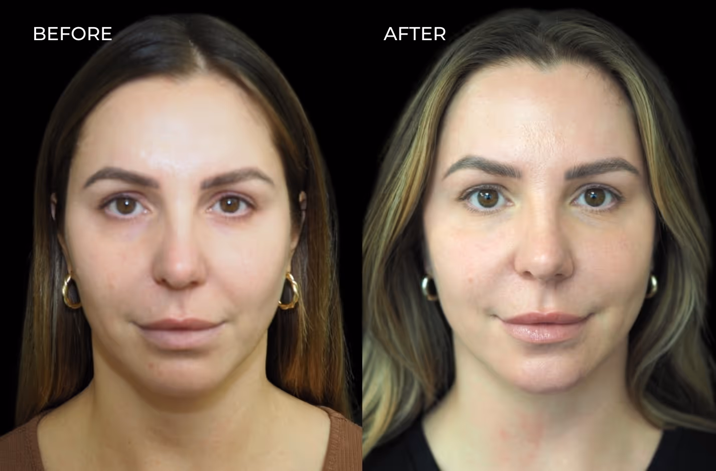Before and after facial balancing with dermal fillers in San Diego