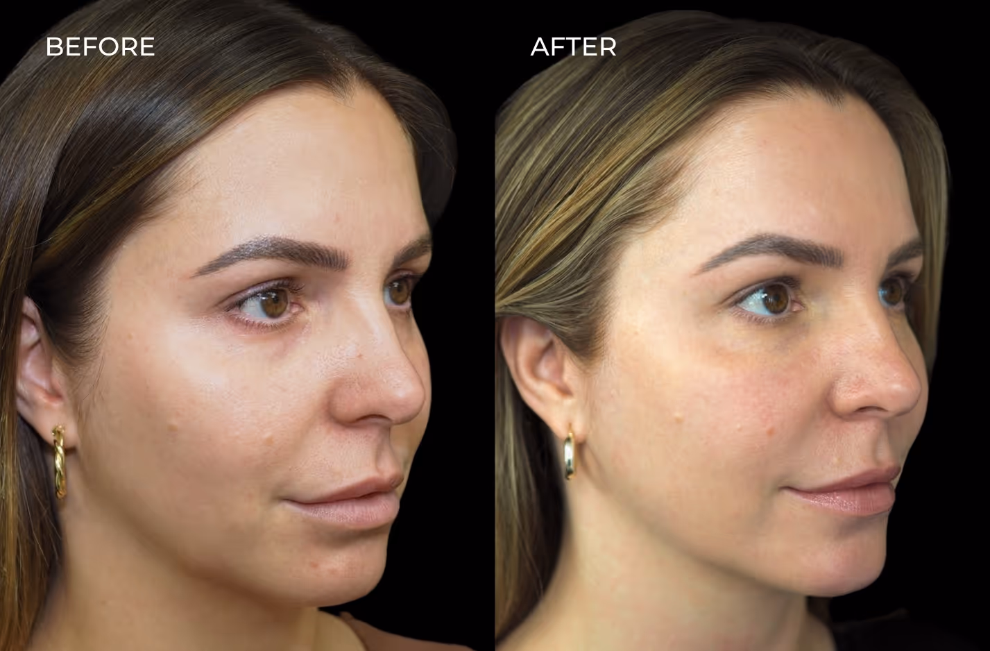 Before and after facial balancing with dermal fillers in San Diego