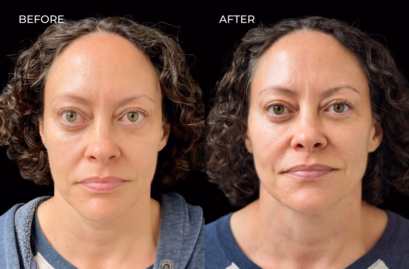 Photo of female patient showing filler results in San Diego