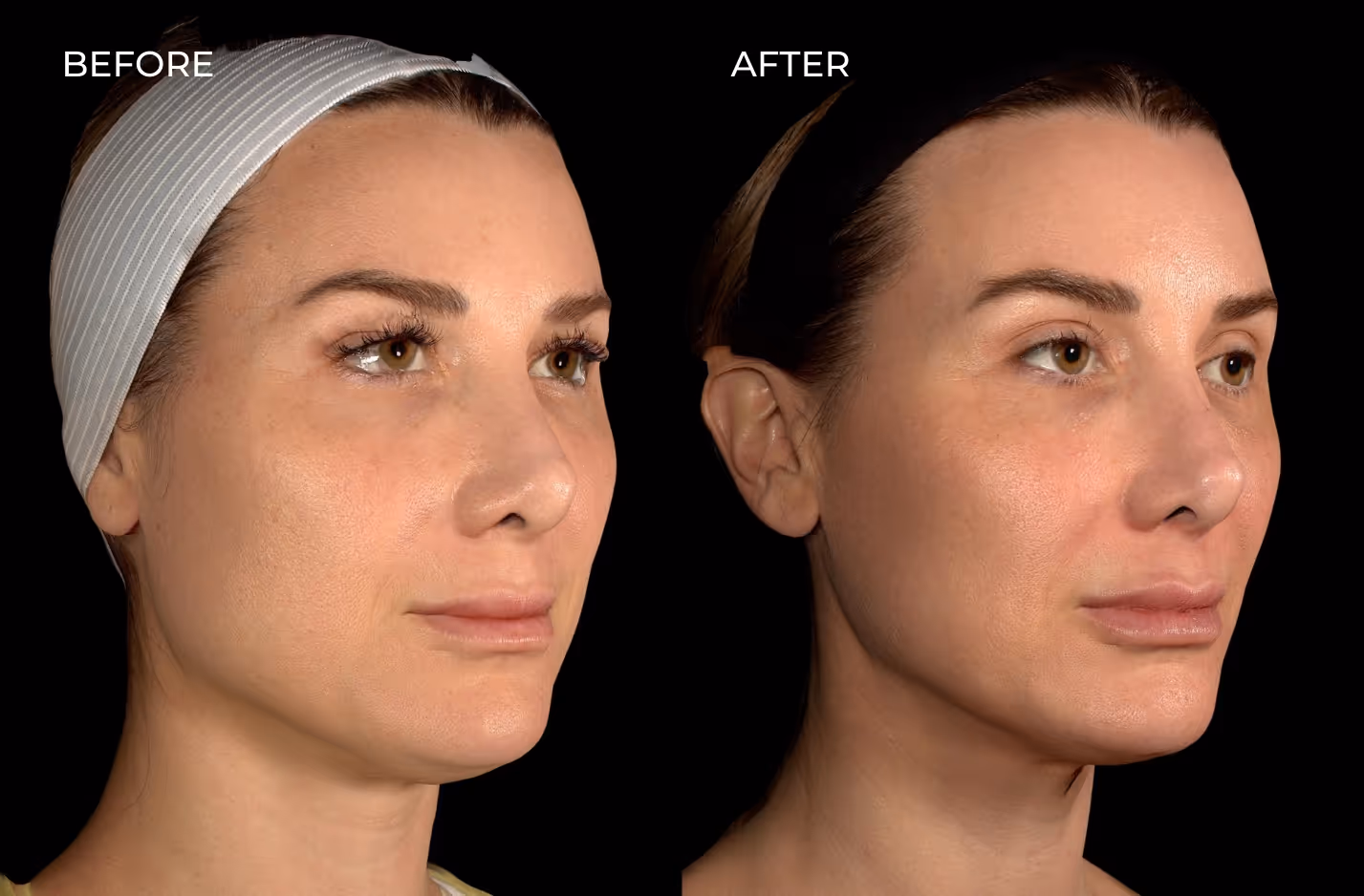 Female patient results before and after combination treatment with Botox and fillers in San Diego