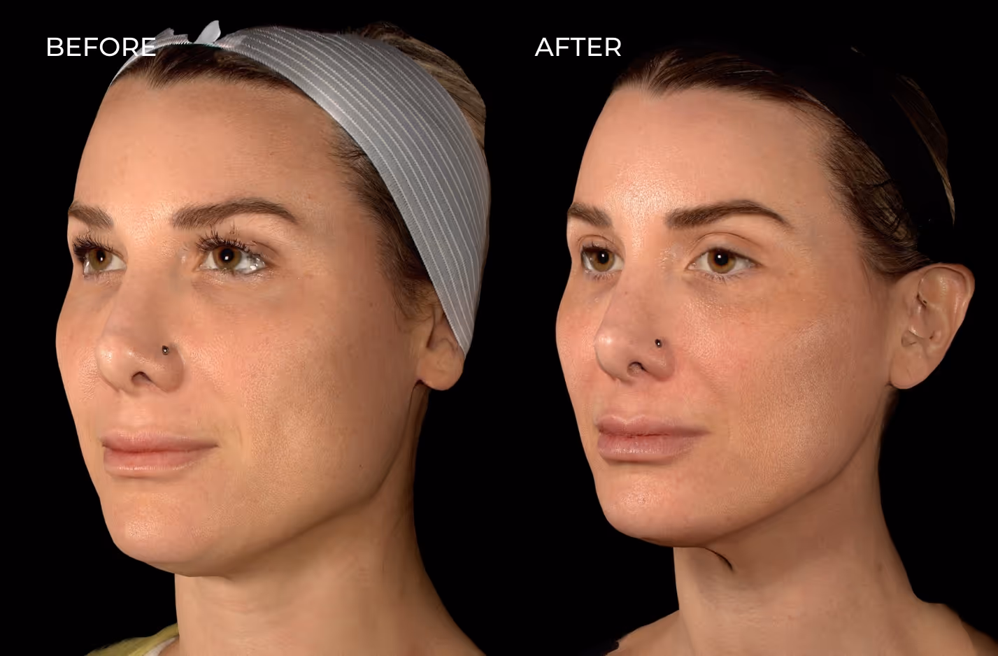 Female patient results before and after combination treatment with Botox and fillers in San Diego