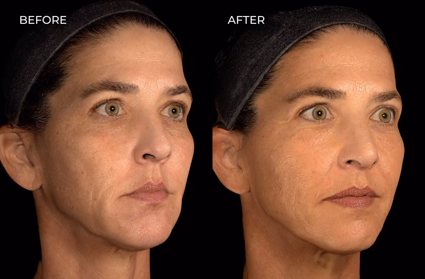 Real patient results from jawline, temple, and chin filler in San Diego