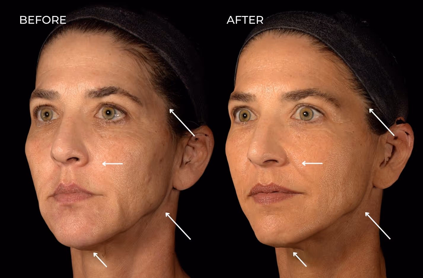 Real patient results from jawline, temple, and chin filler in San Diego