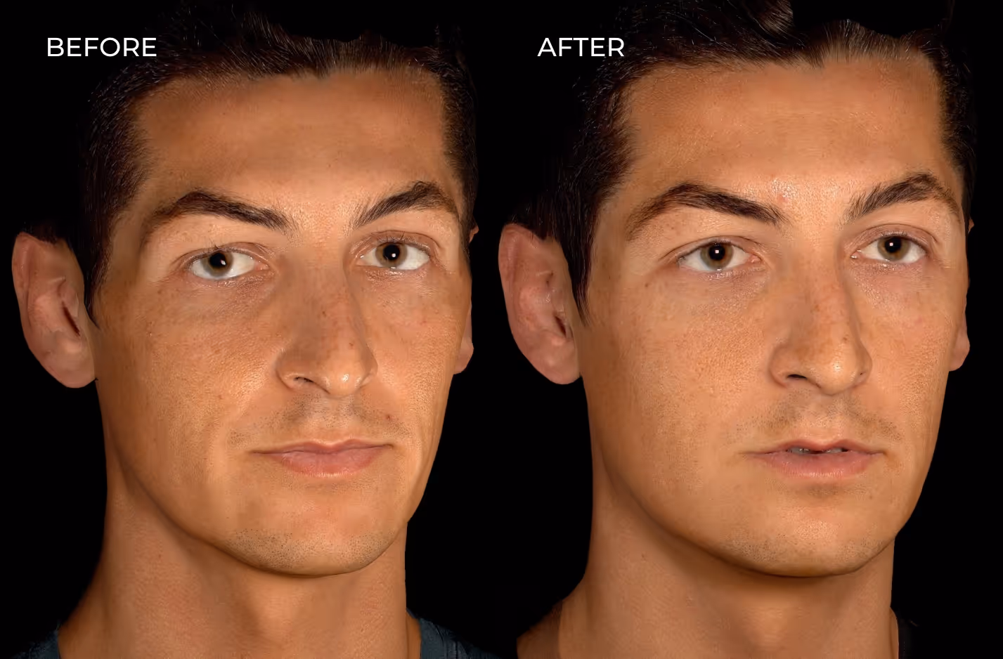 Male patient before and after temple fillers in San Diego