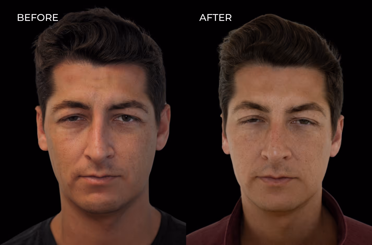 Frontal view of a male patient's results before and after Botox in San Diego