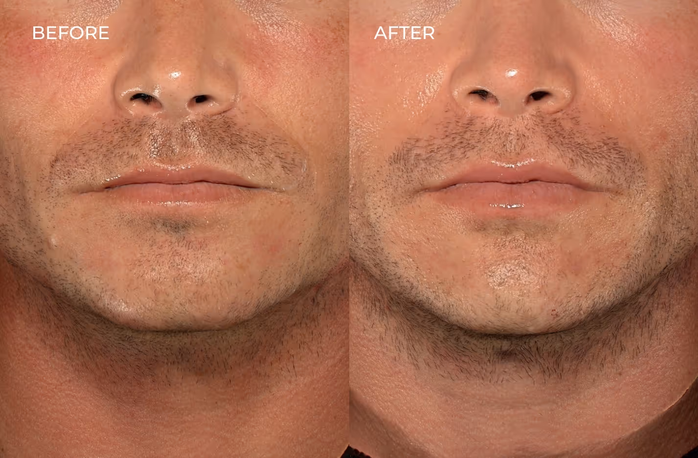 Real patient before and after lip fillers in San Diego