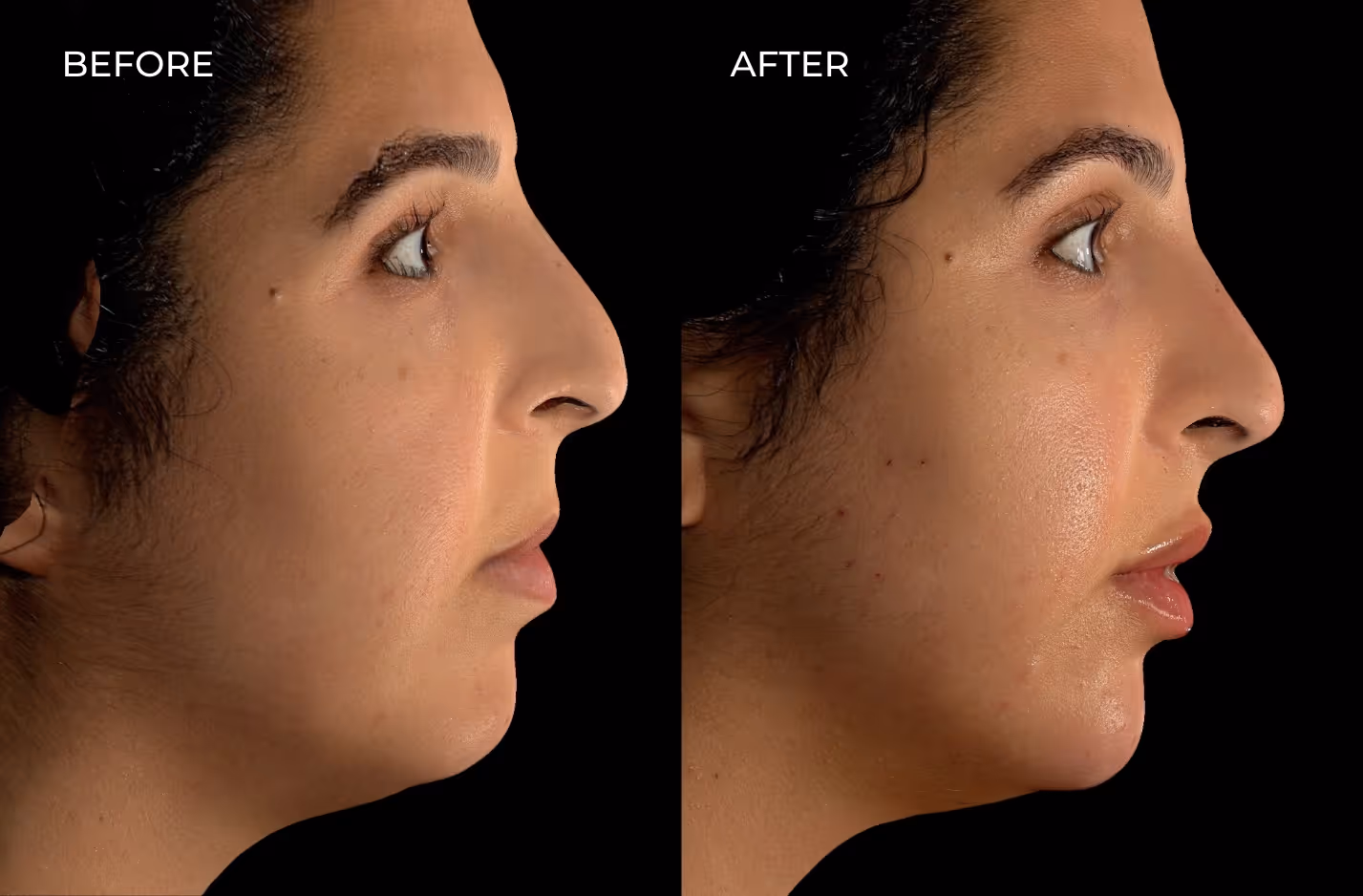 Female patient before and after fillers in San Diego