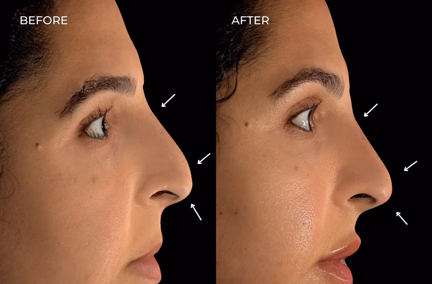 Before and after fillers for non-surgical rhinoplasty in San Diego