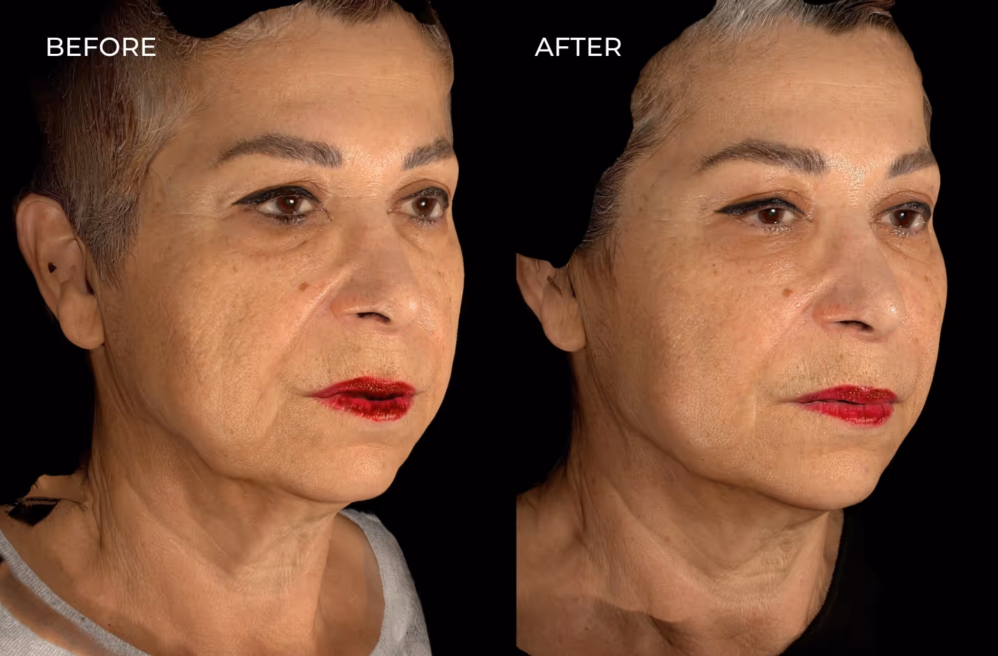 Before and after fillers for facial rejuvenation in San Diego