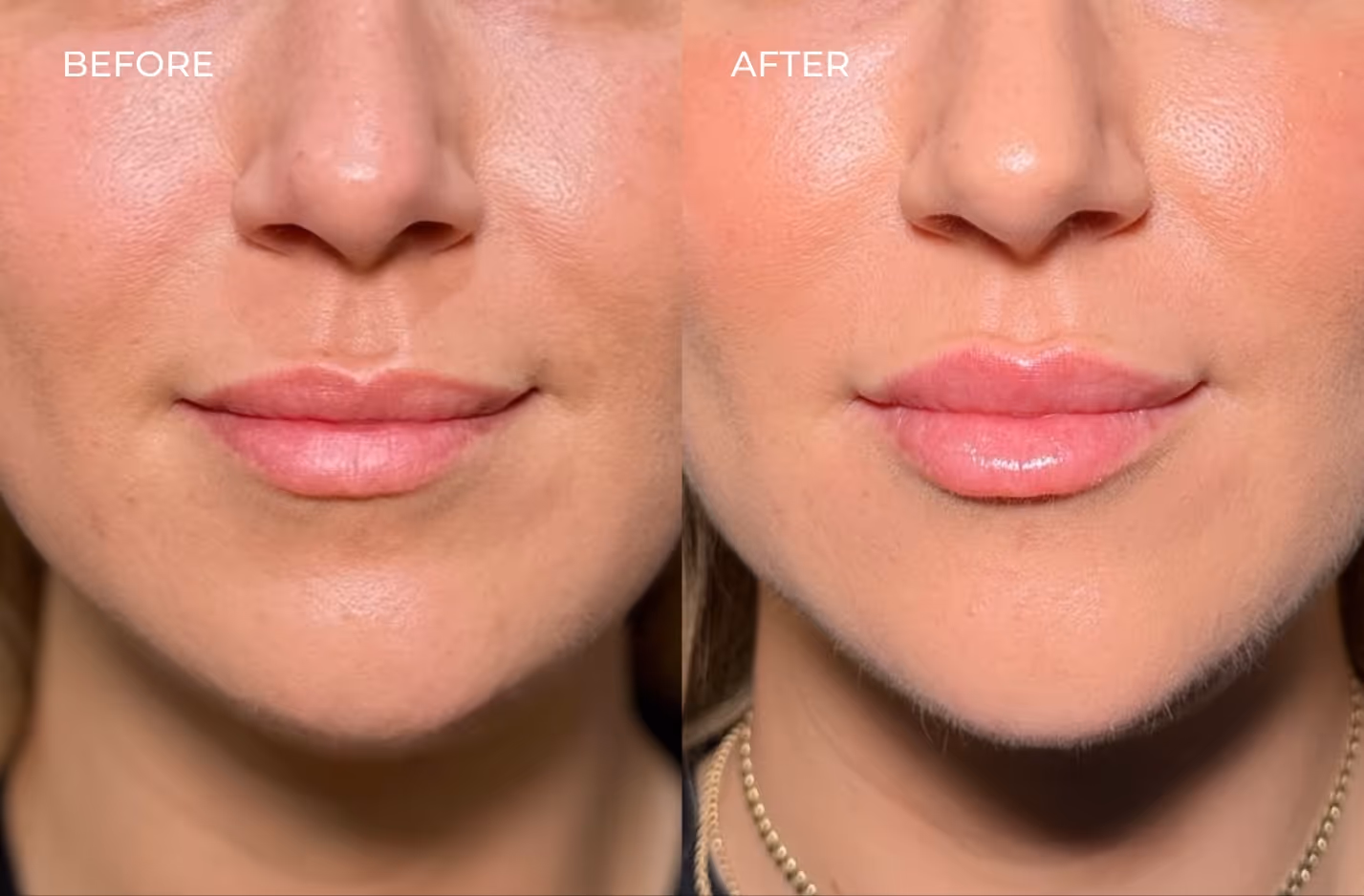 Lip filler results in San Diego