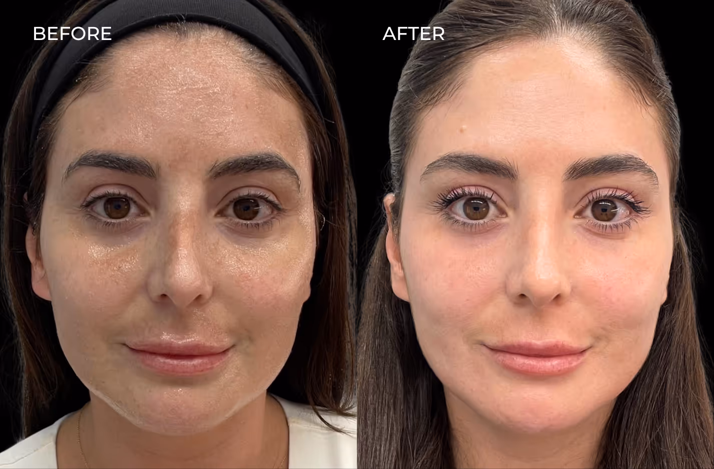 Frontal view of female patient results before and after botox in San Diego