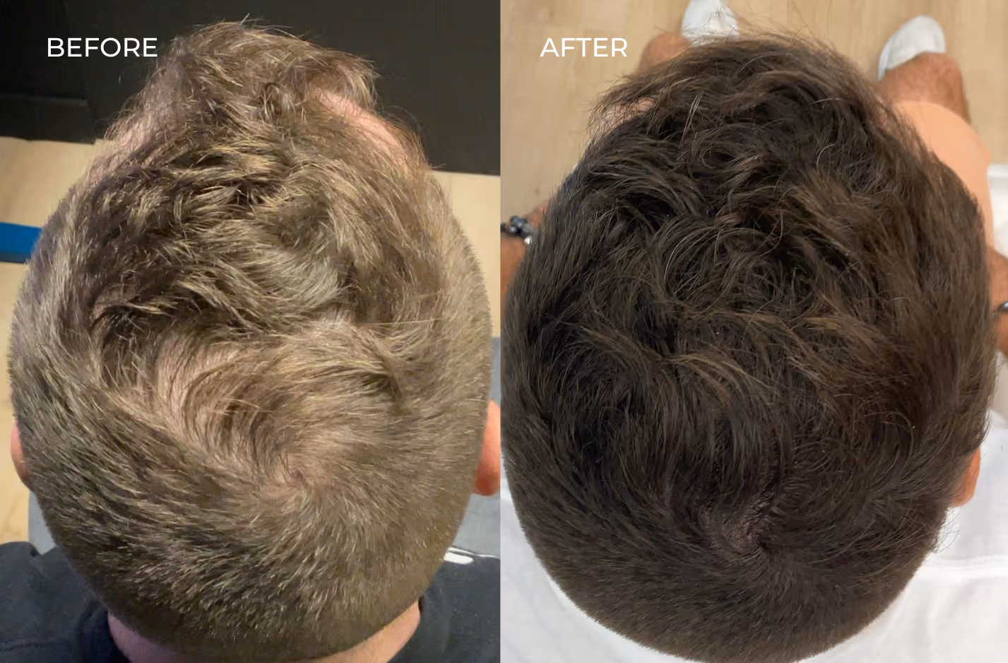Top down view of male patient before and after exosome therapy for hair restoration in San Diego