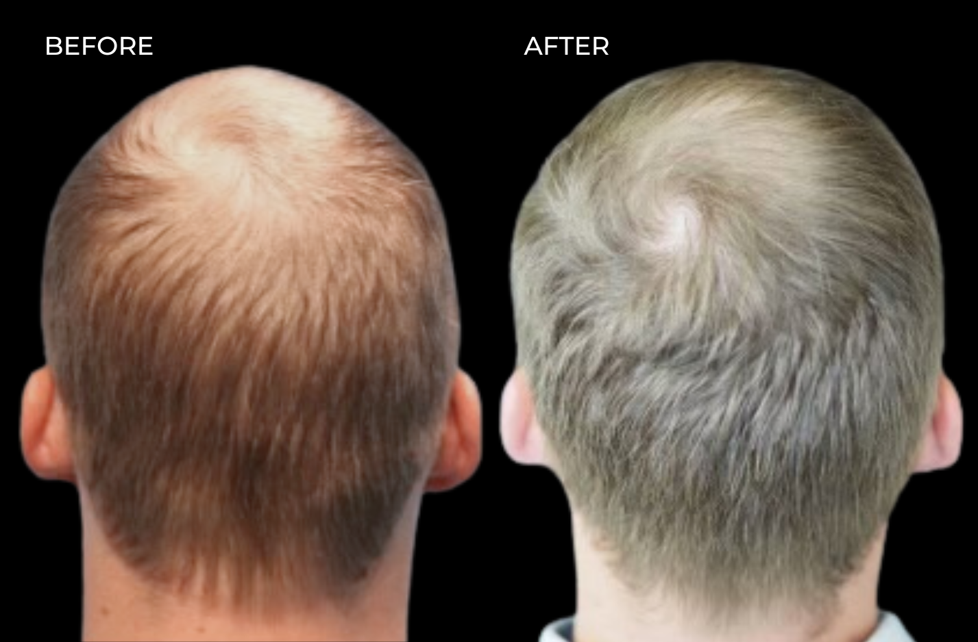 Top down view of male patient before and after hair restoration in San Diego