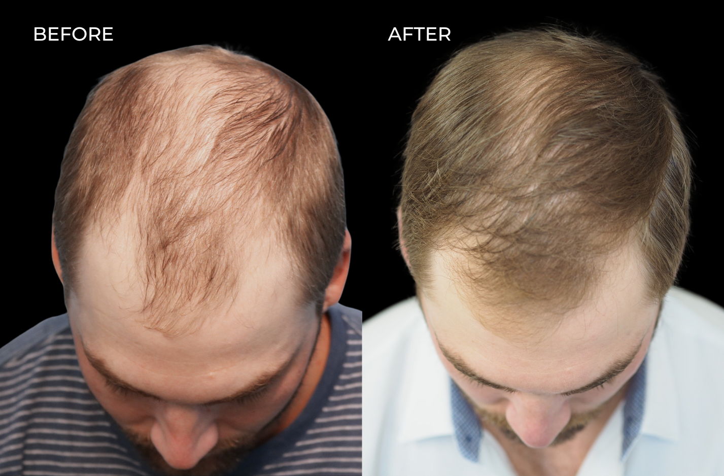 Top down view of male patient before and after hair restoration in San Diego
