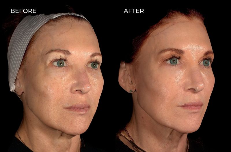 Female patient before and after a variety of treatments including Botox and dermal fillers in San Diego