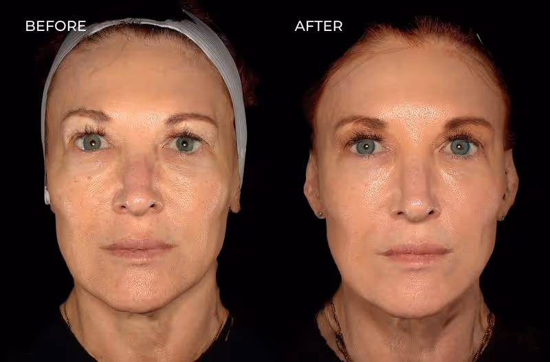 Female patient before and after a variety of treatments including Botox and dermal fillers in San Diego