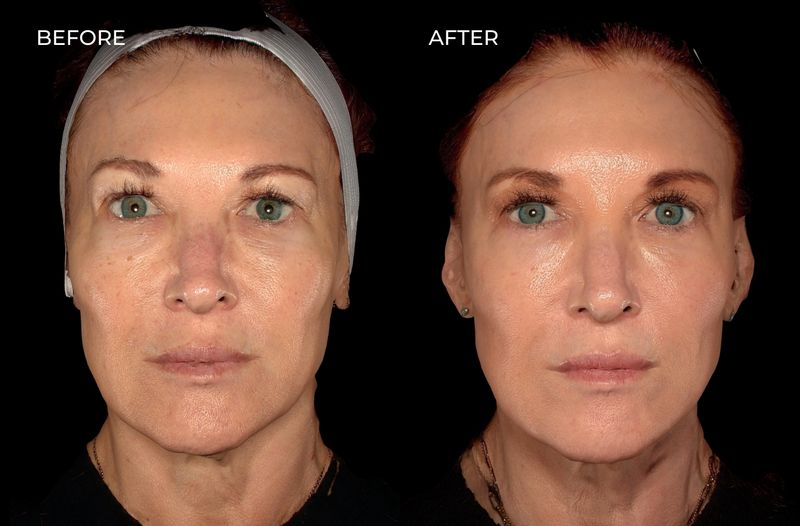 Female patient before and after a variety of treatments including Botox and dermal fillers in San Diego