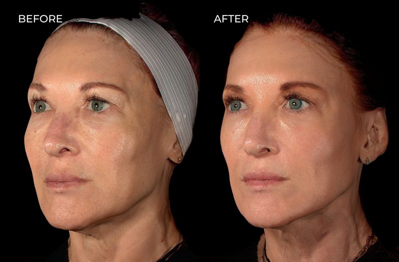 Female patient before and after a variety of treatments including Botox and dermal fillers in San Diego