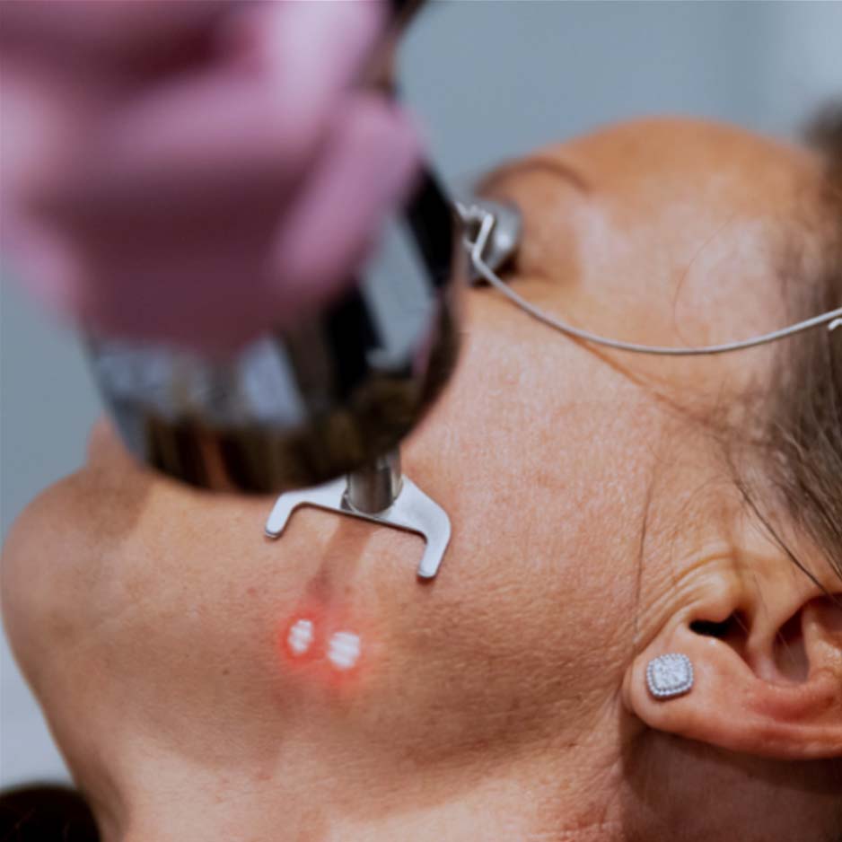 Profractional laser deep skin resurfacing acne scars wrinkles San Diego SOM Aesthetics