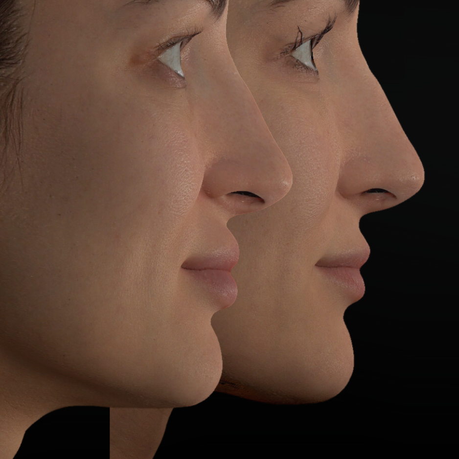 Filler dissolution hyaluronidase reverse HA filler San Diego SOM Aesthetics expert injector