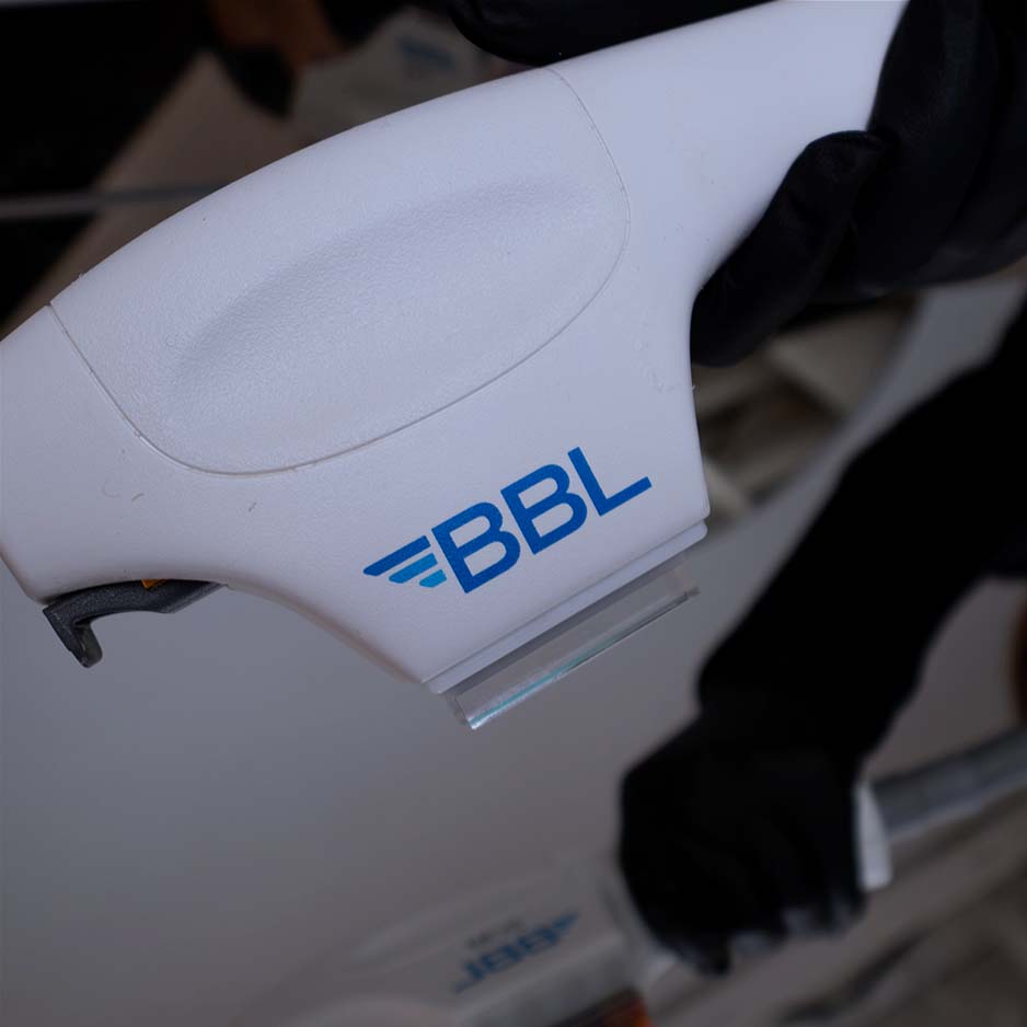 BBL HERO IPL skin rejuvenation sun damage age spots San Diego SOM Aesthetics