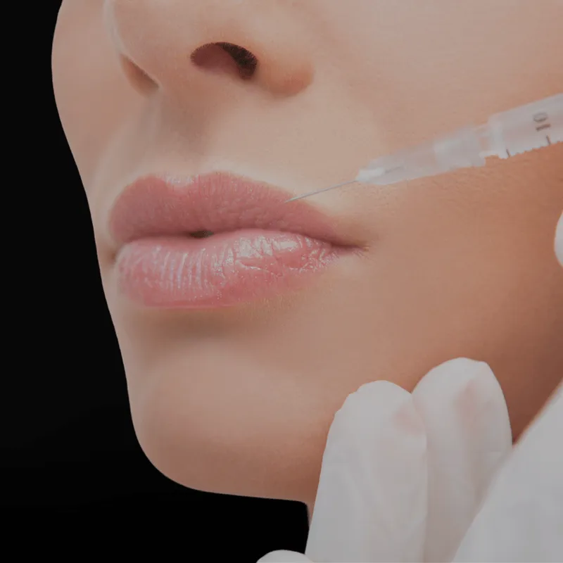 Lip flip Botox upper lip enhancement natural pout San Diego SOM Aesthetics