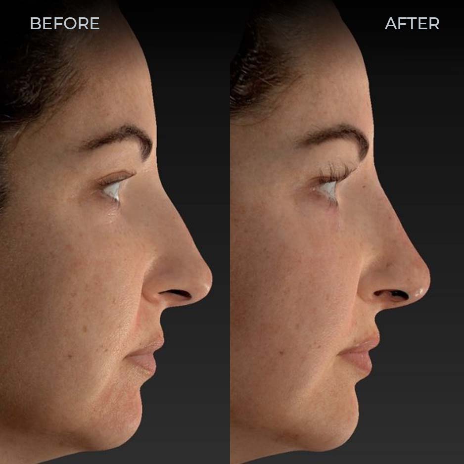 Liquid rhinoplasty non-surgical nose job filler San Diego SOM Aesthetics Dr Khalifian