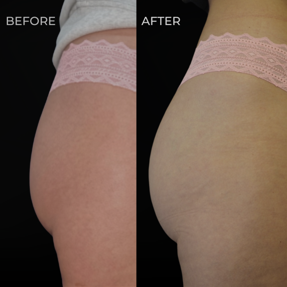 Liquid booty lift Sculptra Radiesse non-surgical BBL San Diego SOM Aesthetics