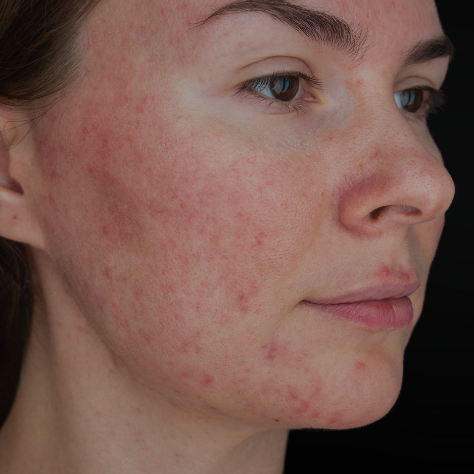 Rosacea skincare treatment dermatologist recommended San Diego SOM Aesthetics