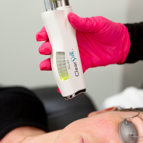 ClearSilk laser redness rosacea gentle skin rejuvenation San Diego SOM Aesthetics