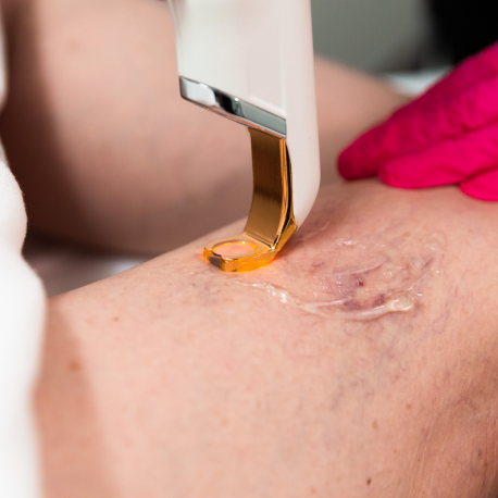 ClearV laser vascular treatment spider veins redness San Diego SOM Aesthetics