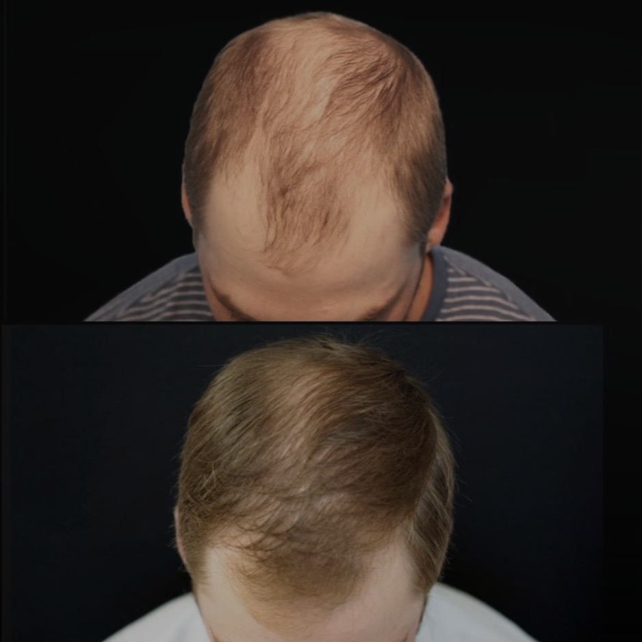 PRP hair restoration platelet rich plasma hair loss treatment San Diego SOM Aesthetics