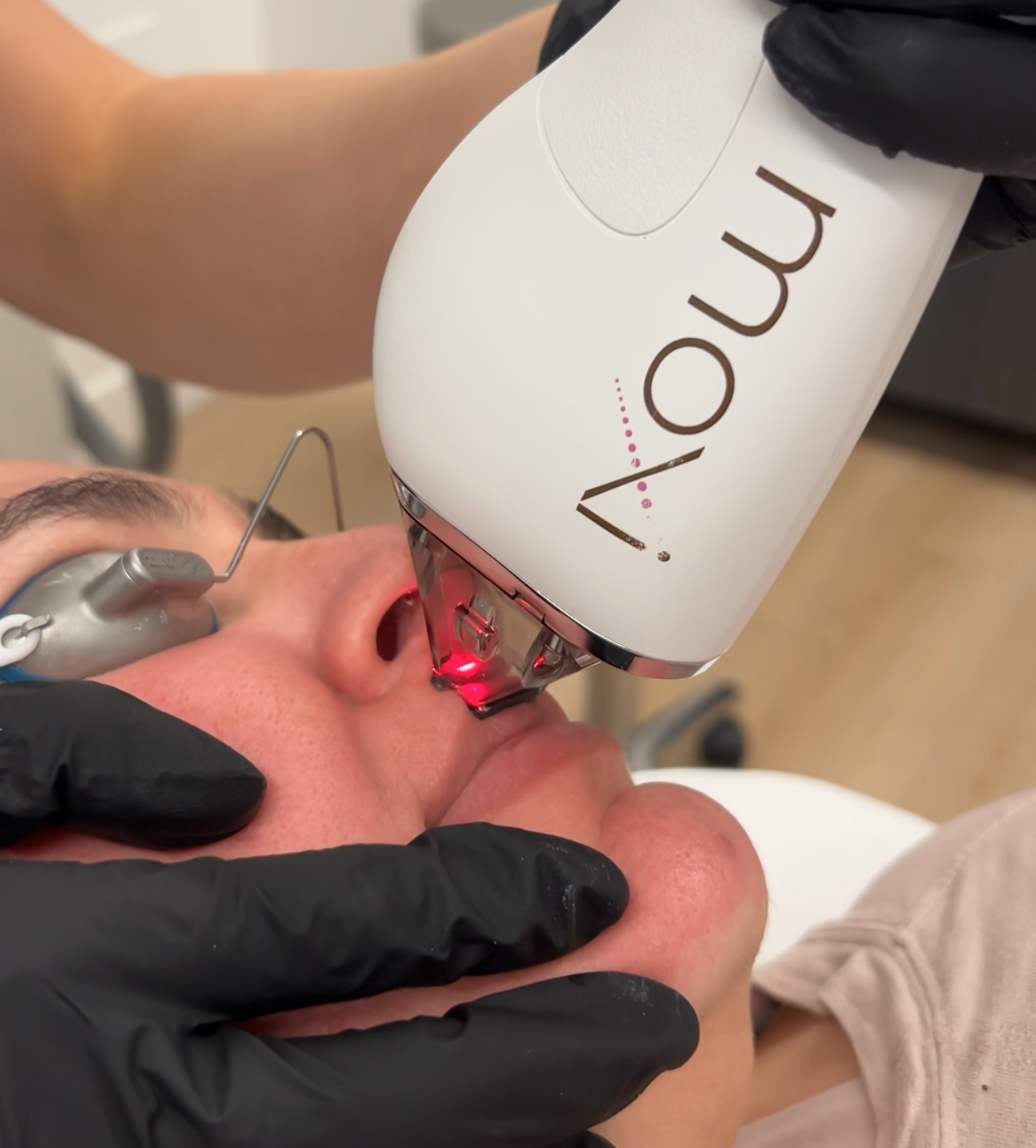 Moxi lunchtime laser facial minimal downtime skin glow San Diego SOM Aesthetics