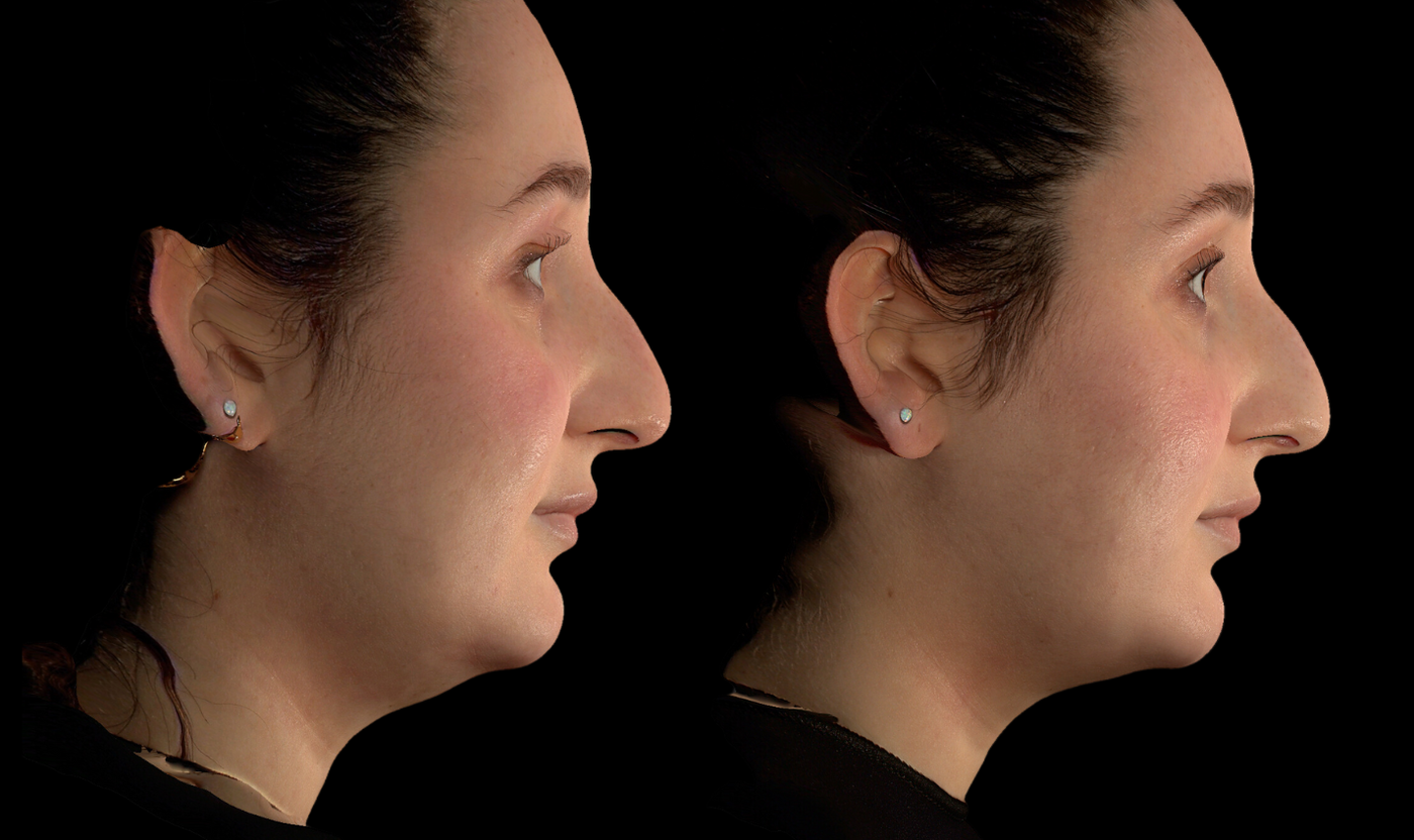 Female patient before and after SylfirmX RF microneedling, profile view
