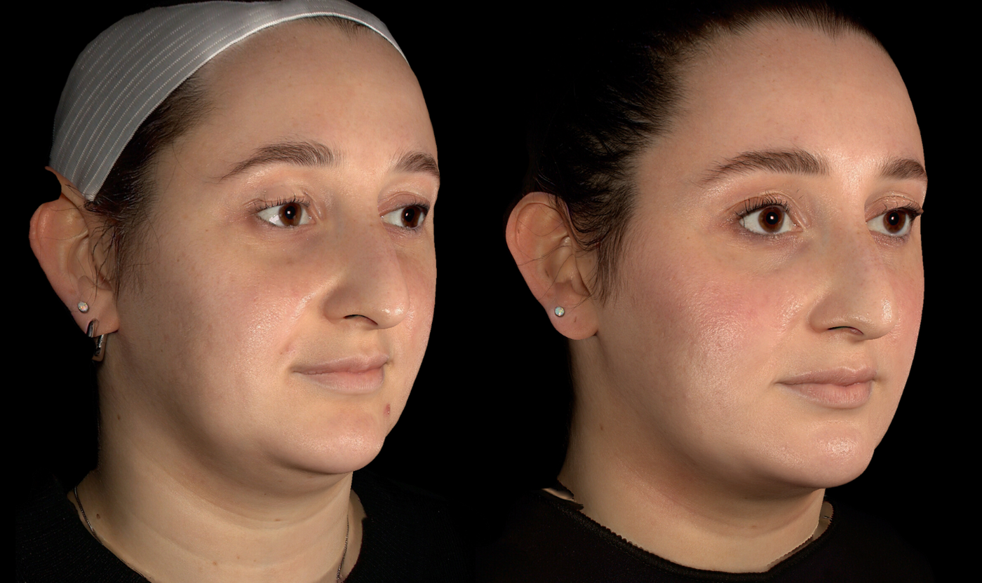 Female patient before and after SylfirmX RF microneedling, angled view