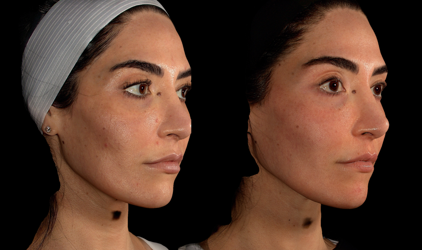Female patient before and after SylfirmX RF microneedling showing skin texture
