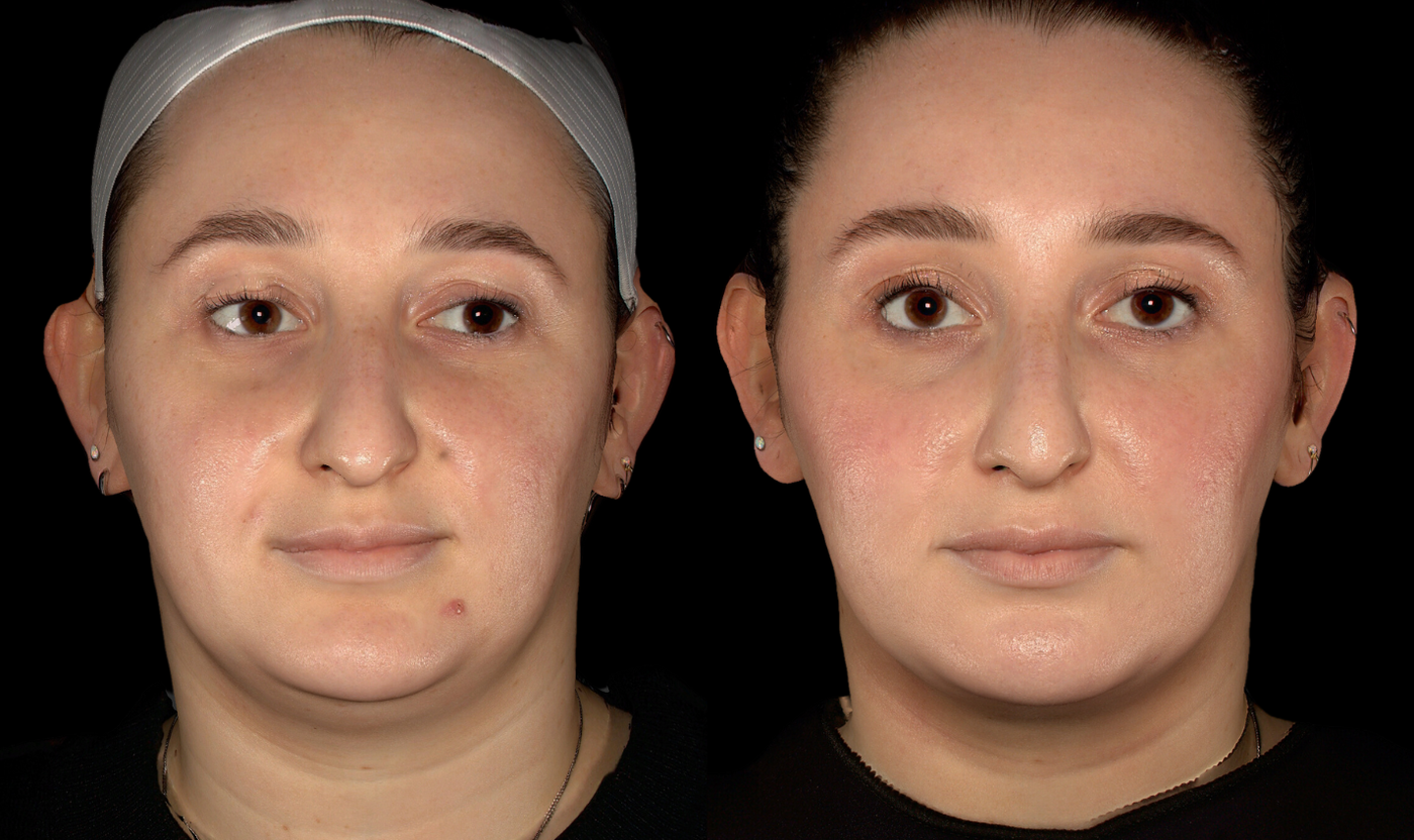Female patient before and after SylfirmX RF microneedling, front view