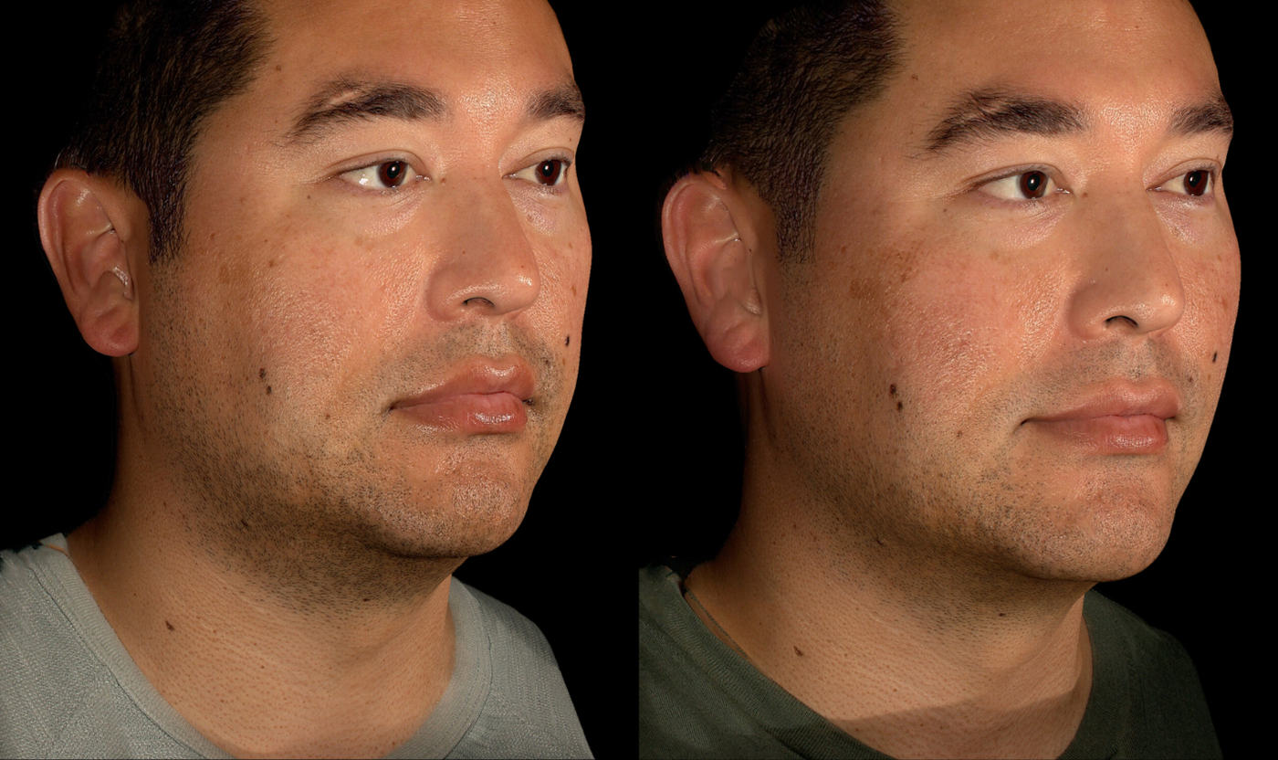 Male patient before and after SylfirmX RF microneedling