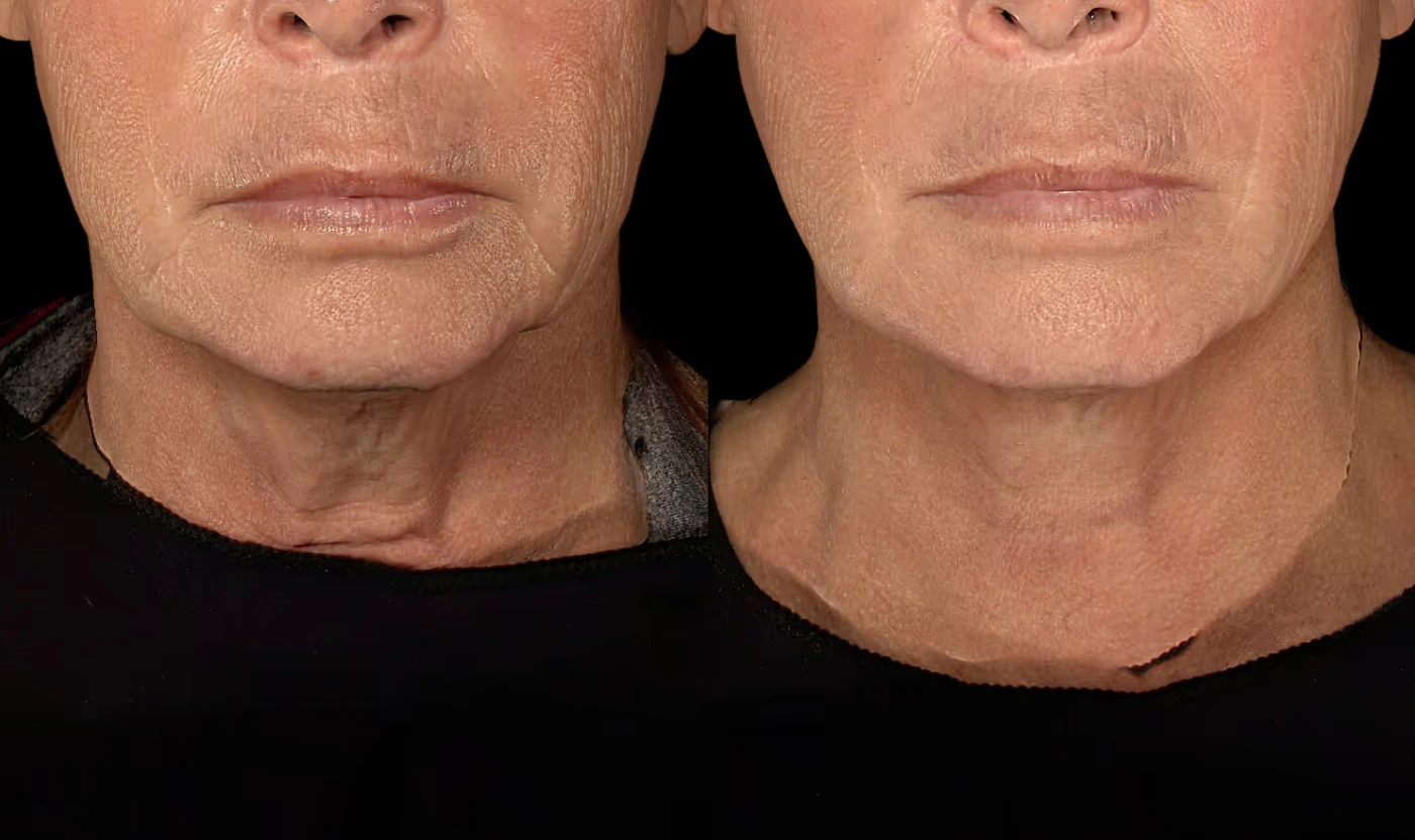 SOM Neck Rejuvenation before and after result, view 2