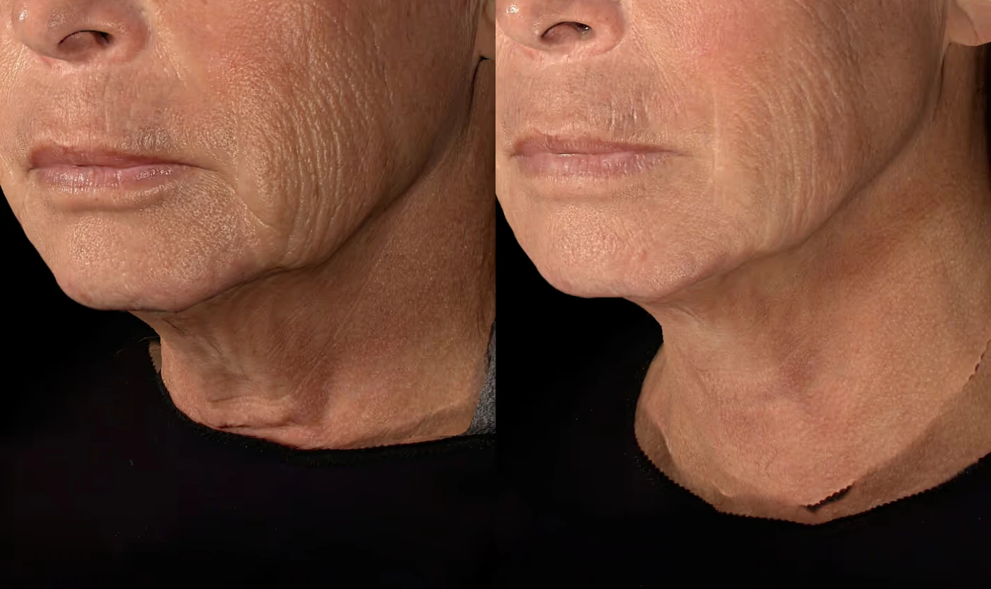SOM Neck Rejuvenation before and after result, view 3