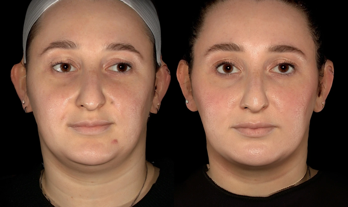 SOM double chin treatment and RF microneedling result, view 2