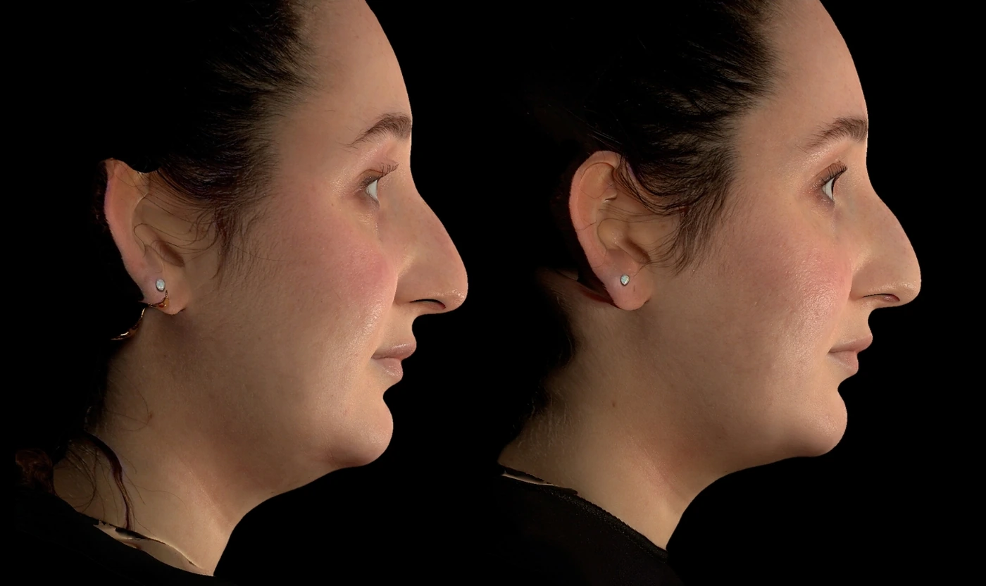 SOM double chin treatment and RF microneedling result, view 3