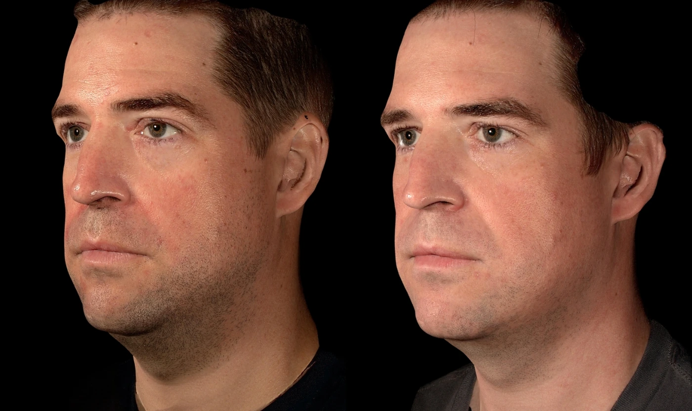 SOM Signature double chin treatment result, view 2
