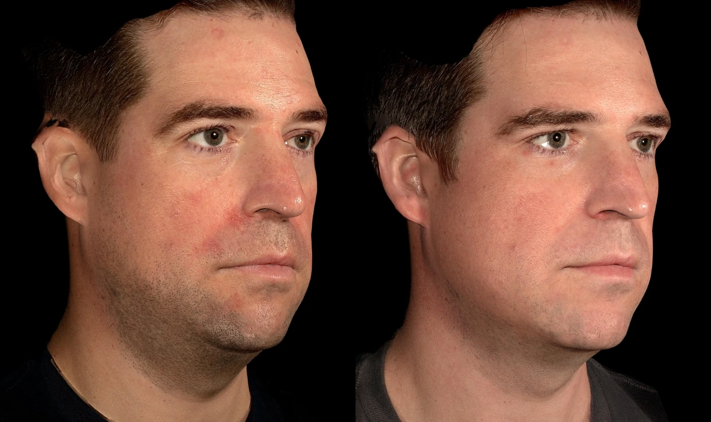 SOM Signature double chin treatment result, view 3