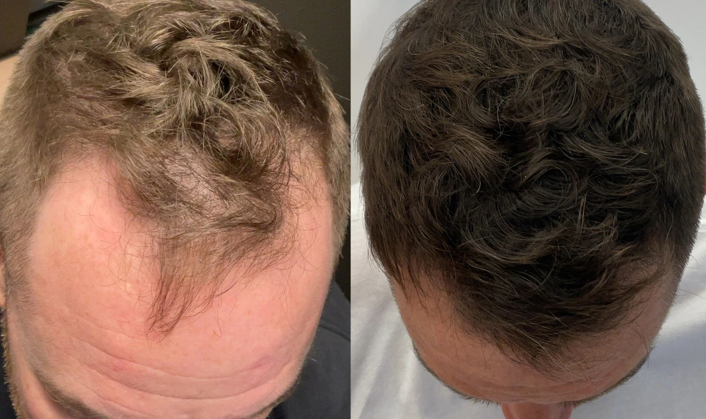 PRP hair restoration before and after result, view 2