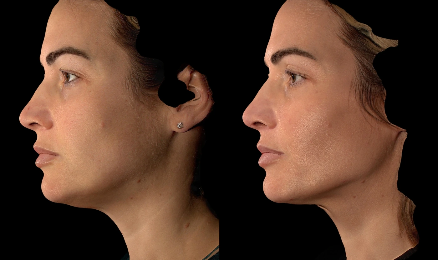 Personalized full-face rejuvenation result, view 2