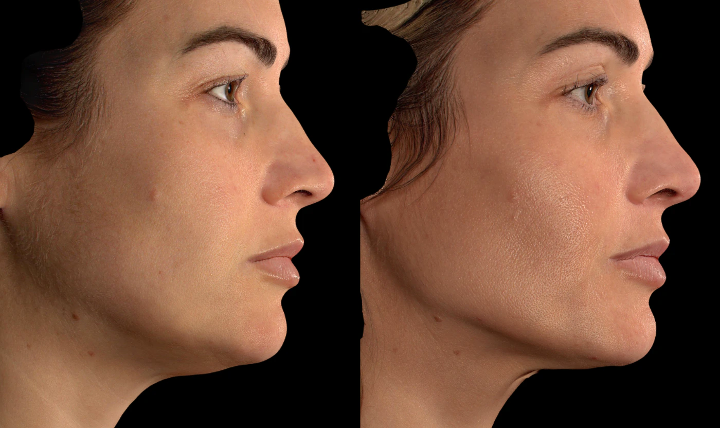Personalized full-face rejuvenation result, view 3